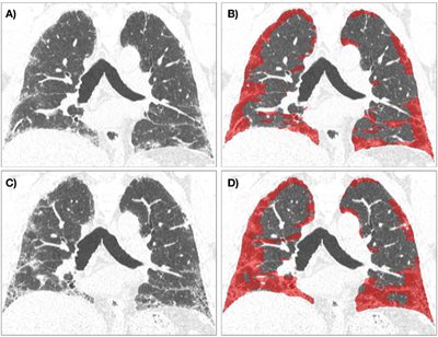 Fibrosis images