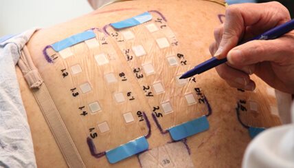 allergy test performed on person's back